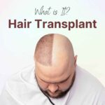 How Hair Transplants Can Boost Your Confidence and Appearance